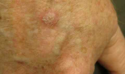 Squamous Cell Carcinoma