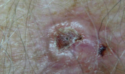 Basal Cell Carcinoma