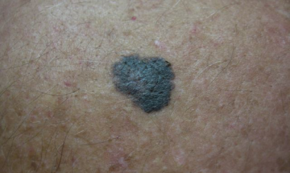 Malignant Melanoma